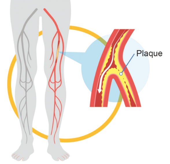 Understanding Peripheral Vascular Disease Causes Symptoms, and Treatment