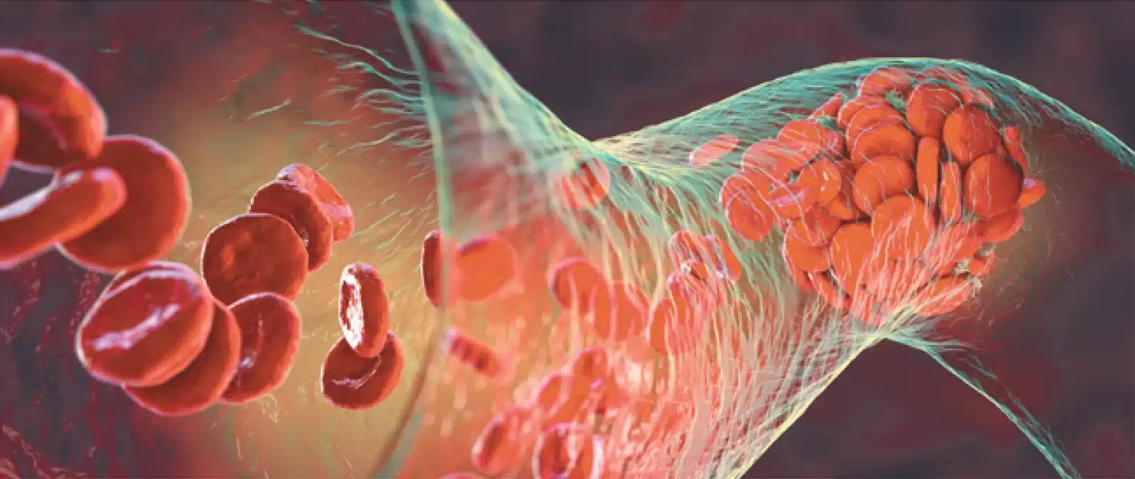 Pulmonary Hypertension