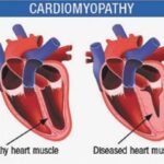 cardiomyopathy